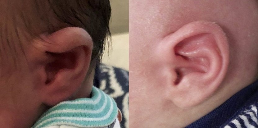 Before and after ear lidding treatment