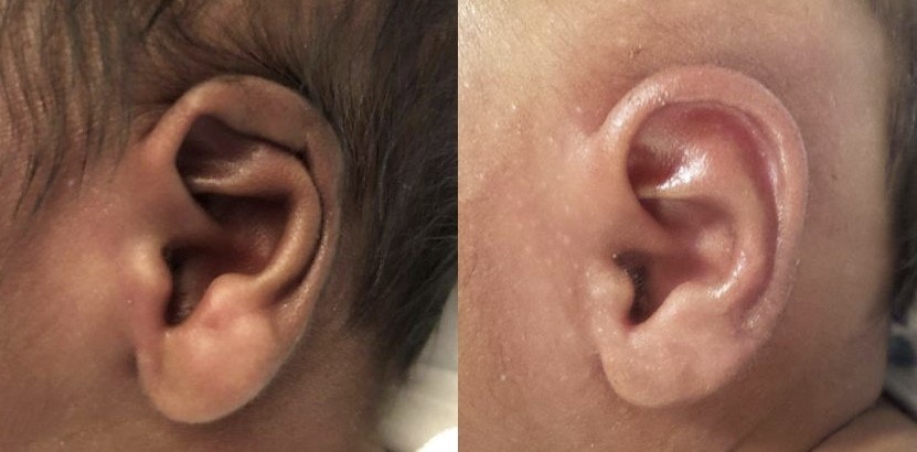 Helical Rim Ear Deformity before and after Ear Molding