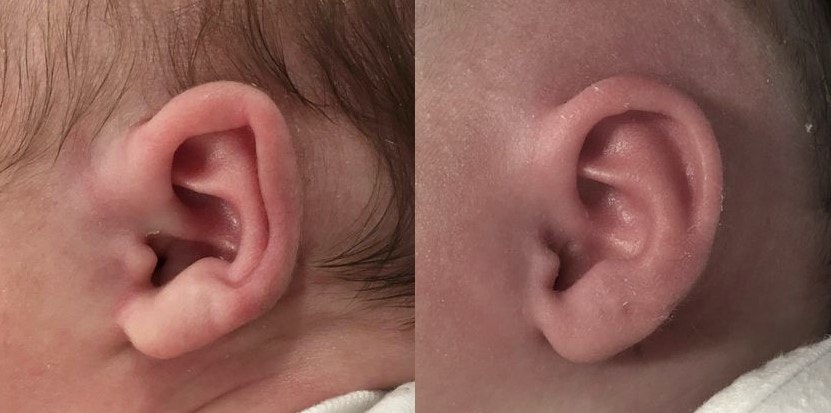 Helical Rim Ear Deformity before and after Ear Molding