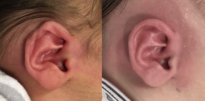 Helical Rim Ear Deformity before and after Ear Molding