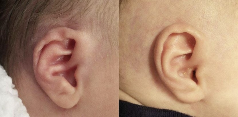Helical Rim Ear Deformity before and after Ear Molding