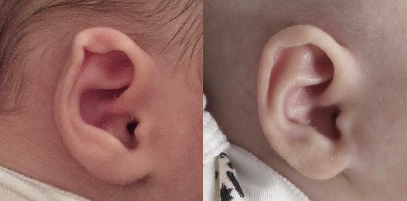 Helical Rim Ear Deformity before and after Ear Molding