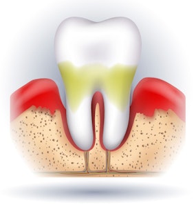 Illustration of advanced gum disease