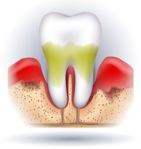 Illustration of severe gum disease