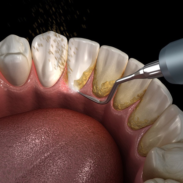 Illustration of tartar and plaque being removed from the back of the teeth