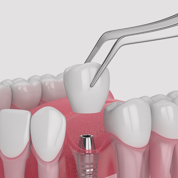 Dental implant