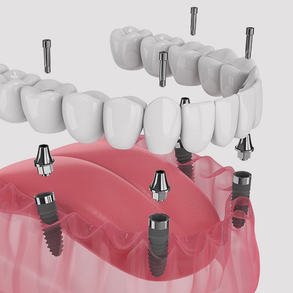 All-on-4 abutments