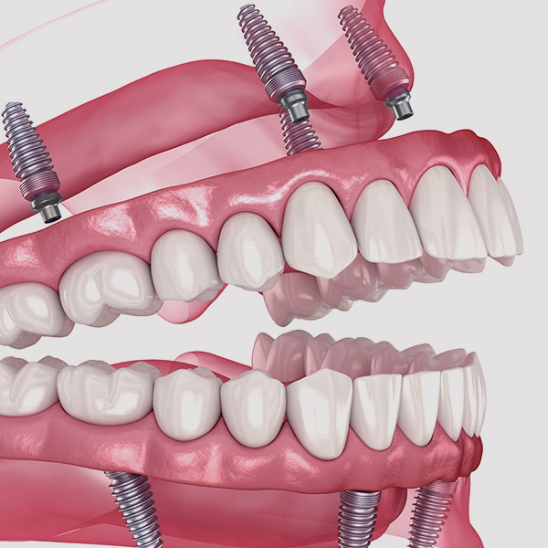 All-on-4 dentures