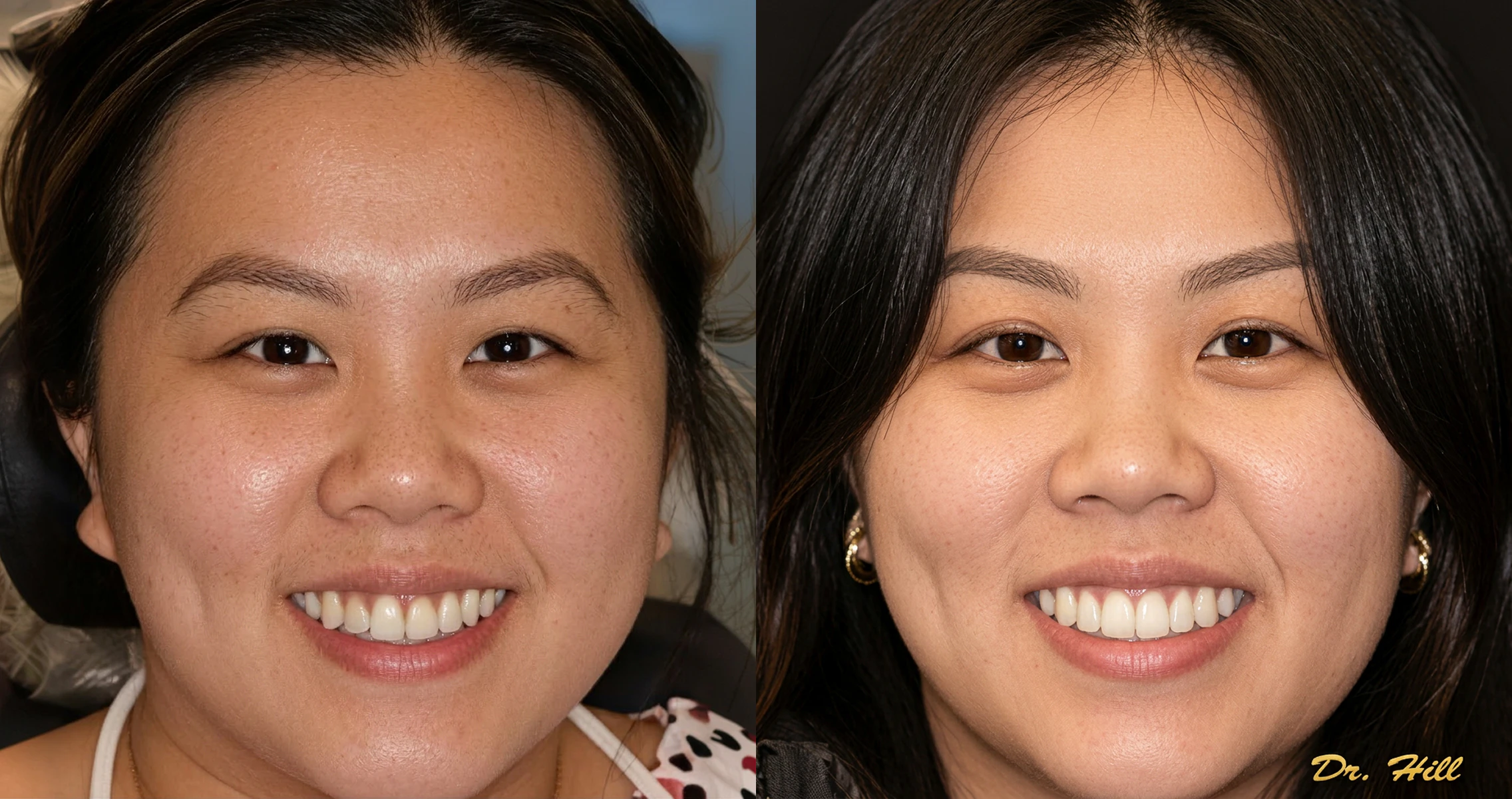 Before and after photos showing a patient