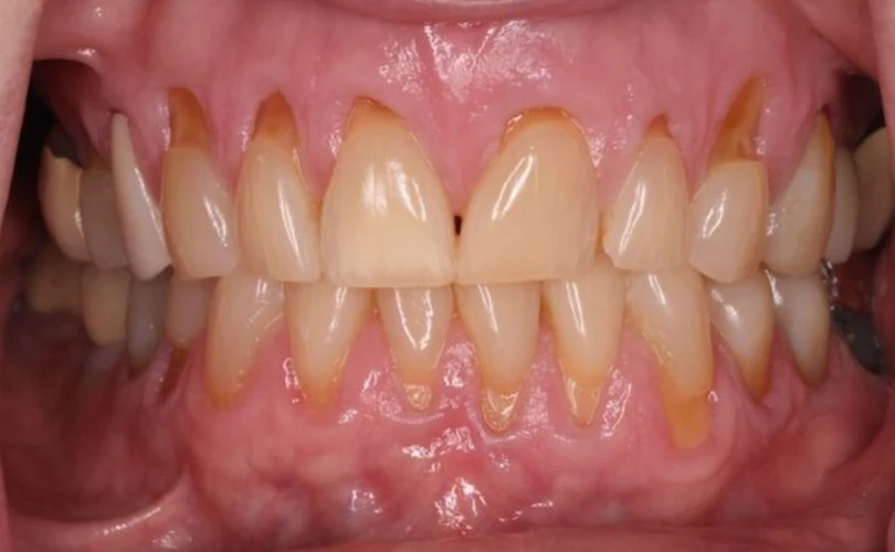 Before Full Mouth Reconstruction