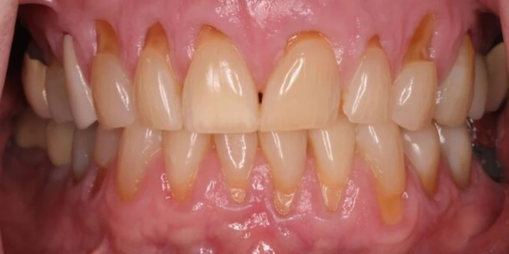 Before Full Mouth Reconstruction