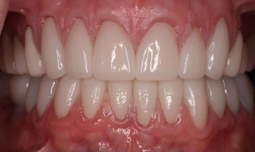 After Full Mouth Reconstruction