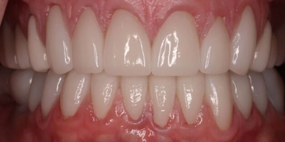 After Full Mouth Reconstruction