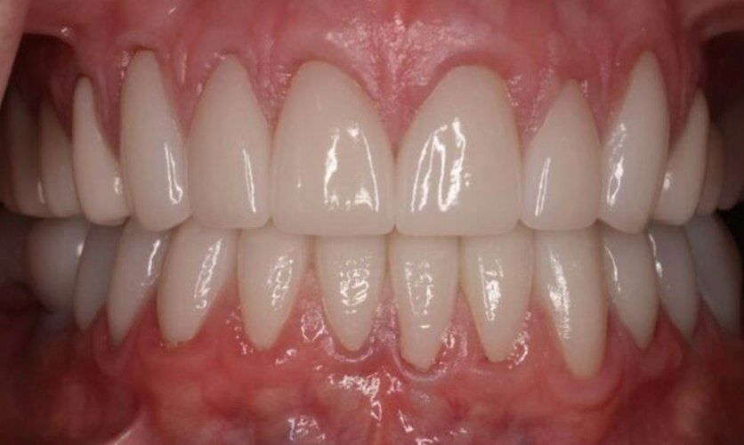 After Full Mouth Reconstruction