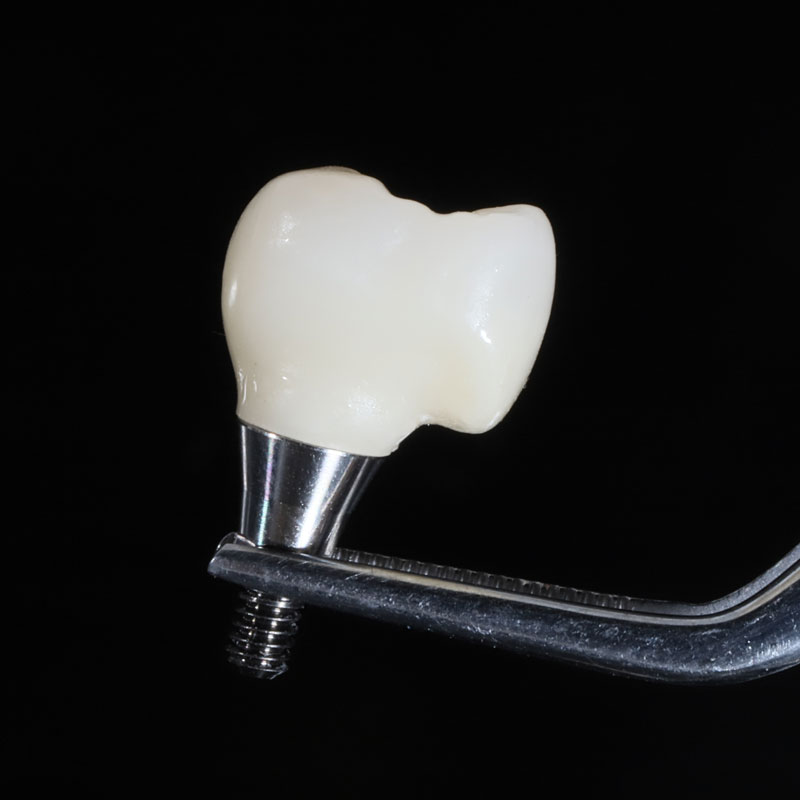 Dental Implant