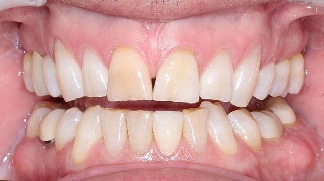 Before photo of dental crowns patient