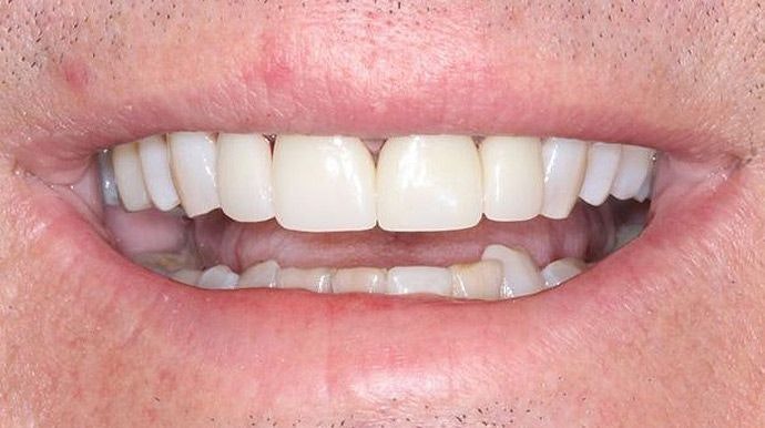 After photo of dental crowns patient