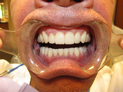 After periodontal and restorative treatment