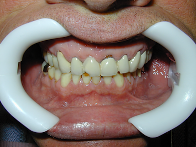 Before periodontal and restorative treatment