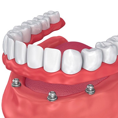 Implant denture