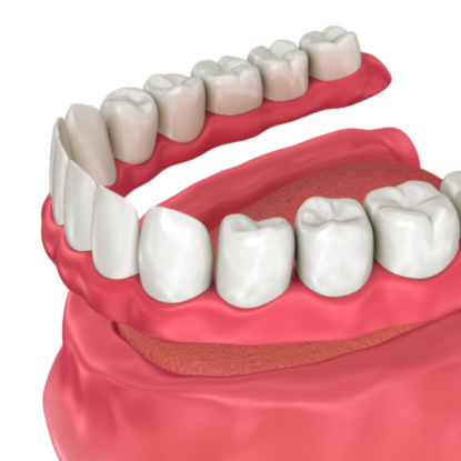 Dentures Scottsdale, AZ - Phoenix, AZ - Dental Works