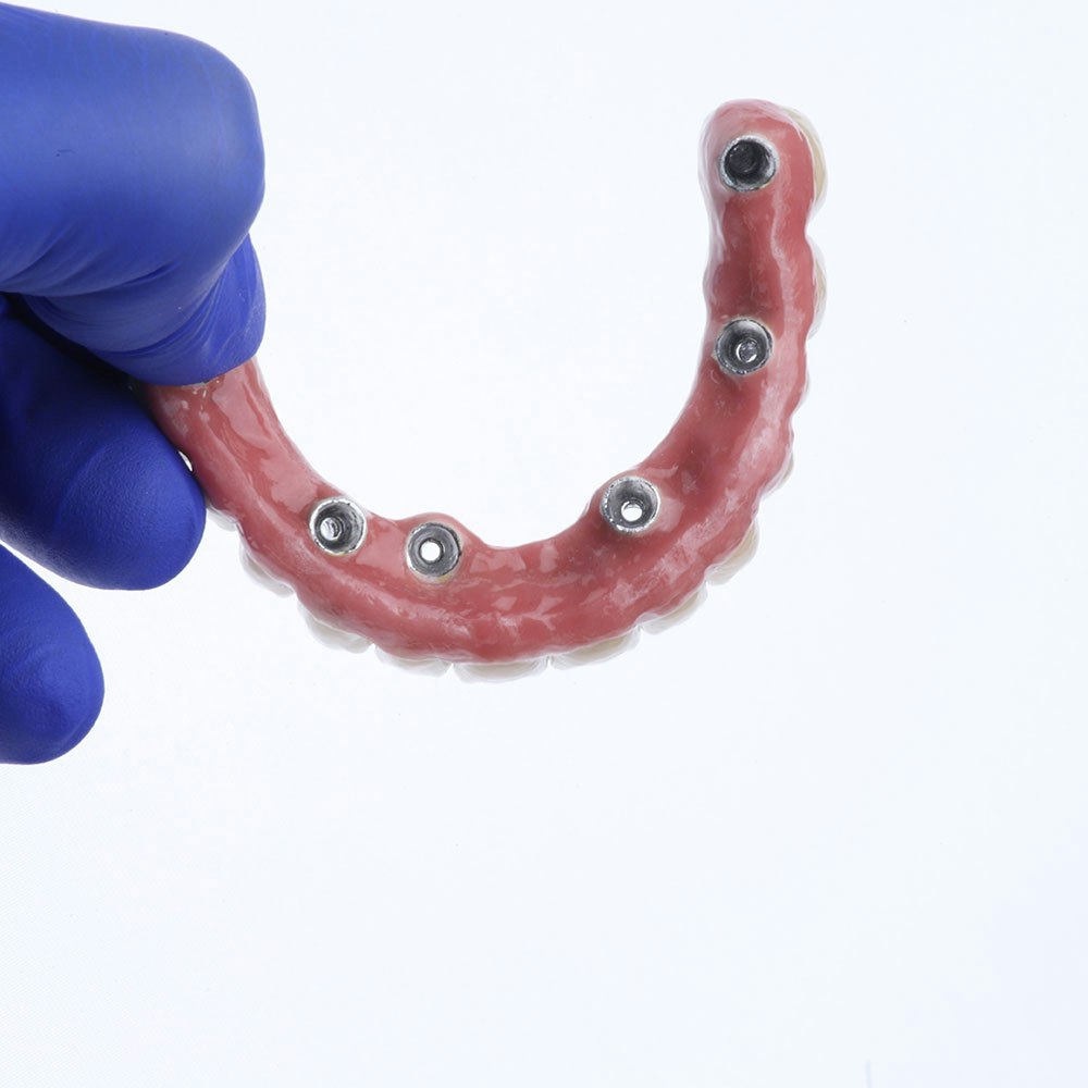 Implant denture
