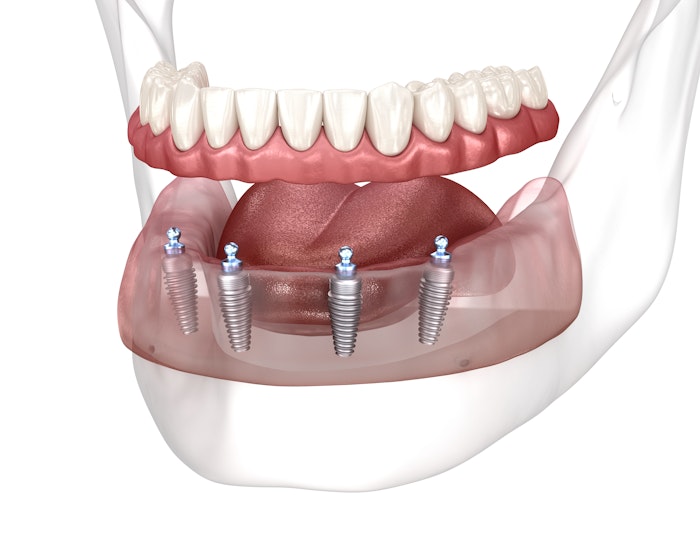 Dentures Using the All-on-4 Method