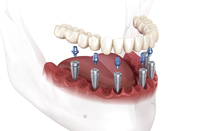 Traditional Implant-Supported Dentures
