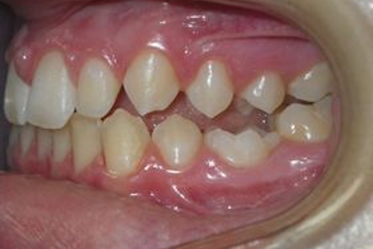 Dental Crown Before