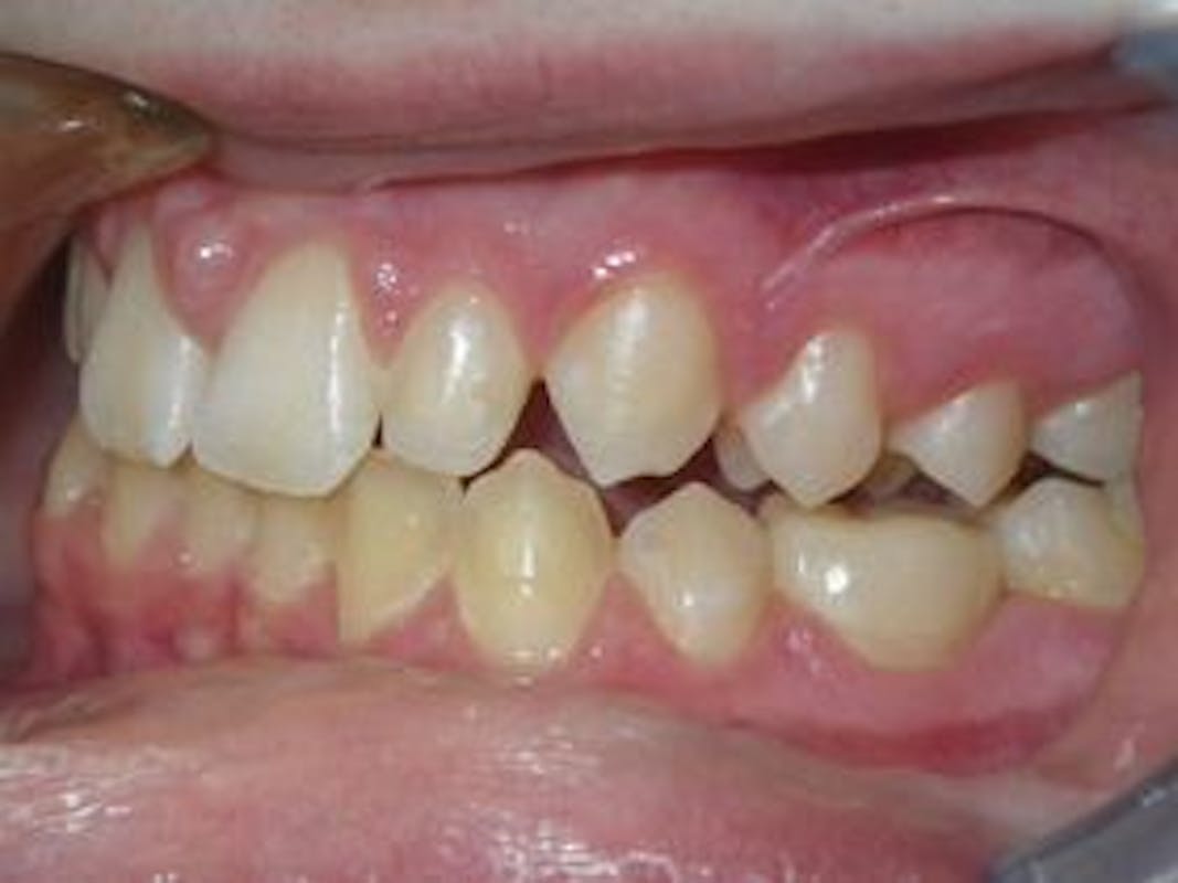 Dental Crown After