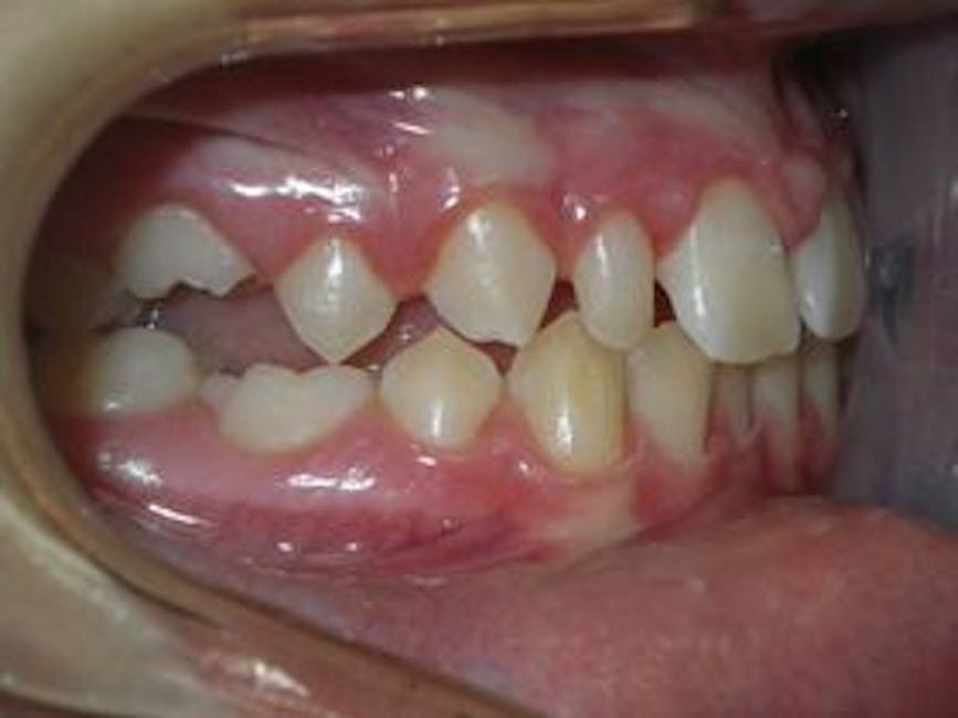 Case 1 before restoration