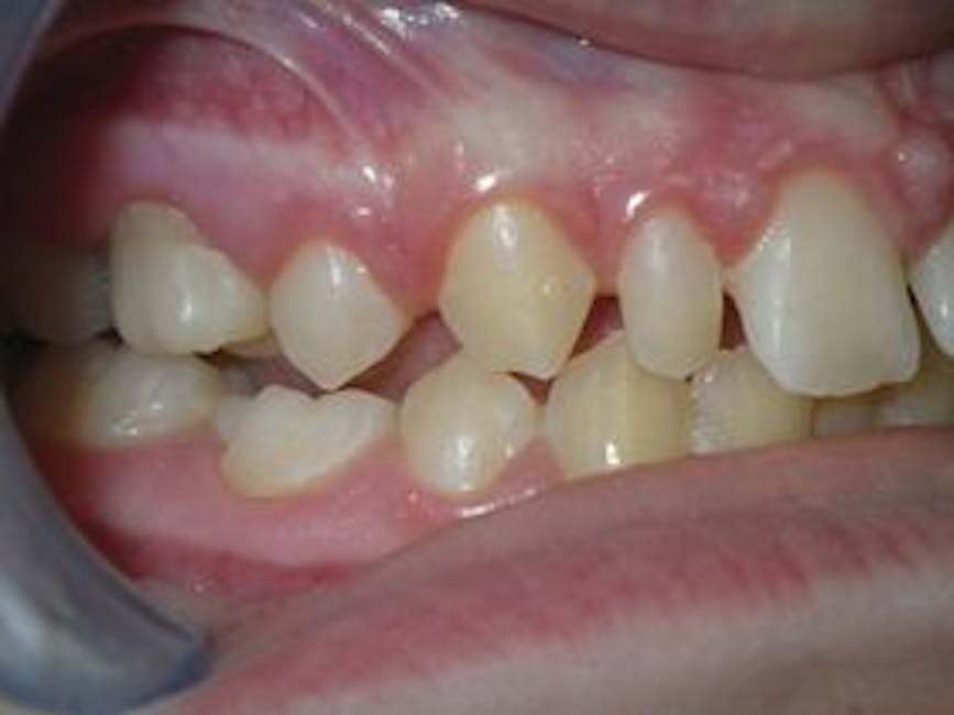 Case 1 after restoration