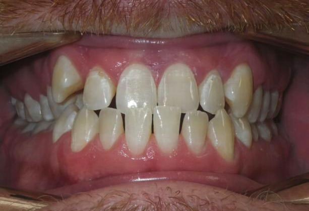 Henderson Dental patient with crossbite