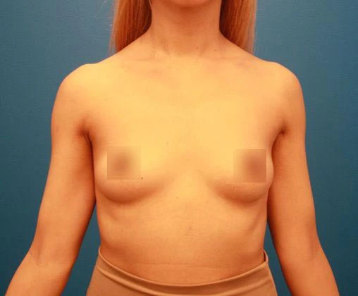 Before breast surgery