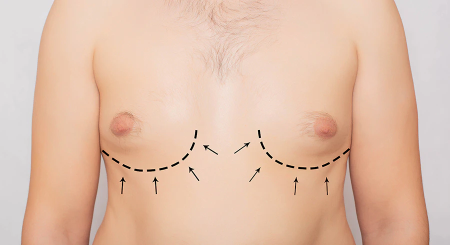Lines on man's chest indicating the effects of gynecomastia surgery