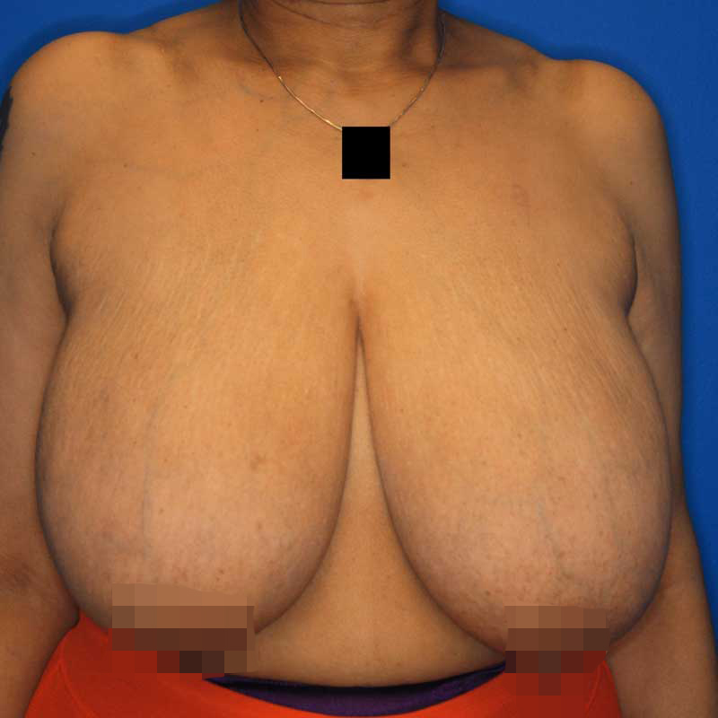 Before breast reduction