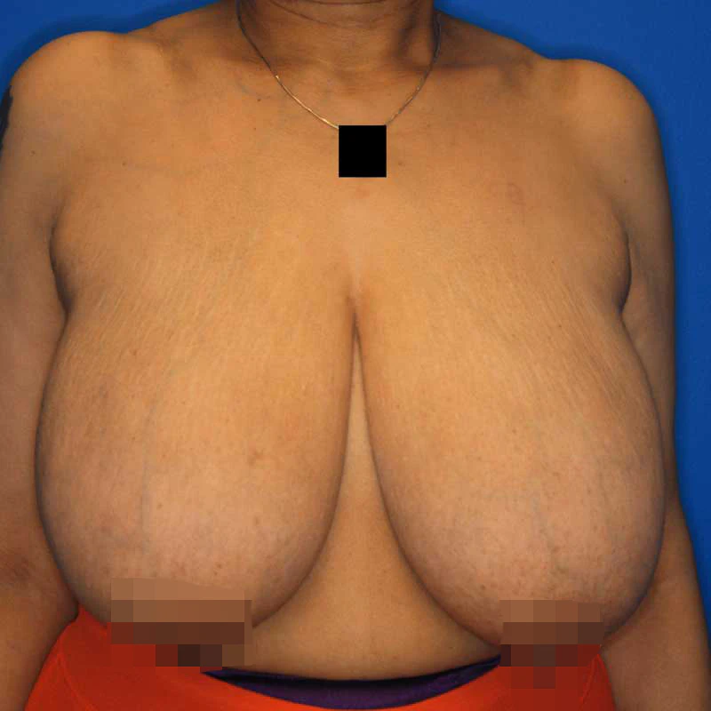 Before breast reduction