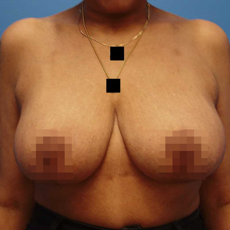 After breast reduction