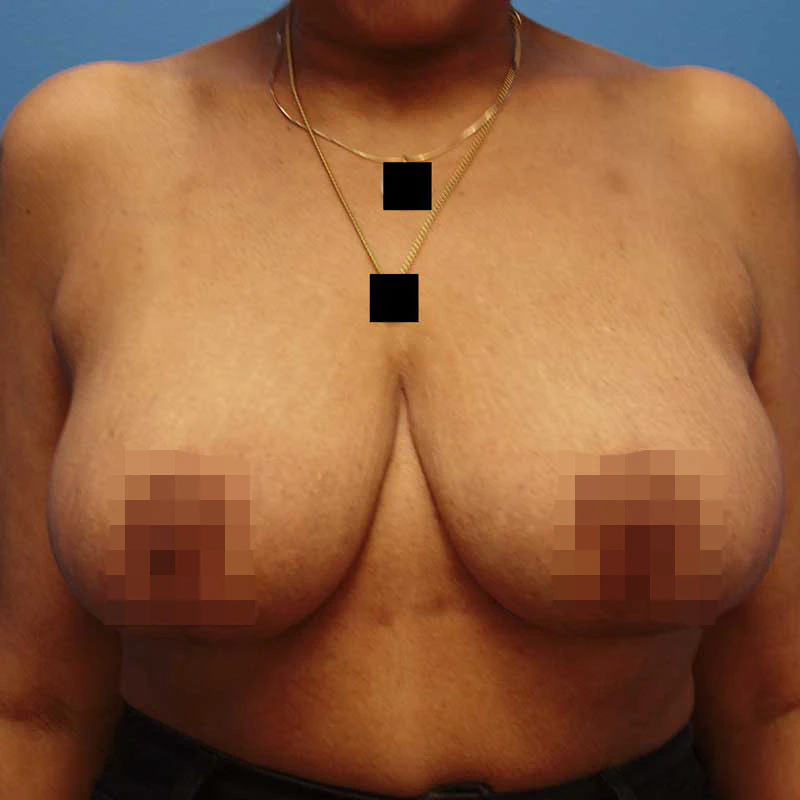 After breast reduction