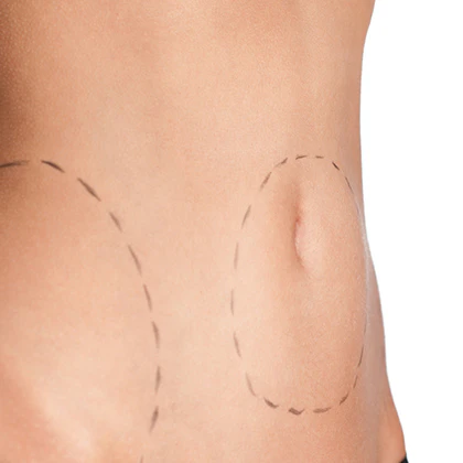 woman's stomach with surgical lines marked