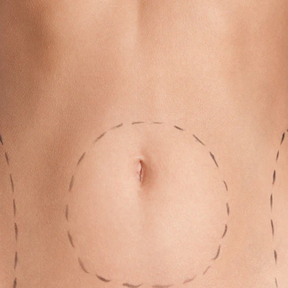 woman's stomach with surgical areas marked