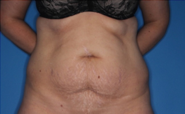 Before body contouring