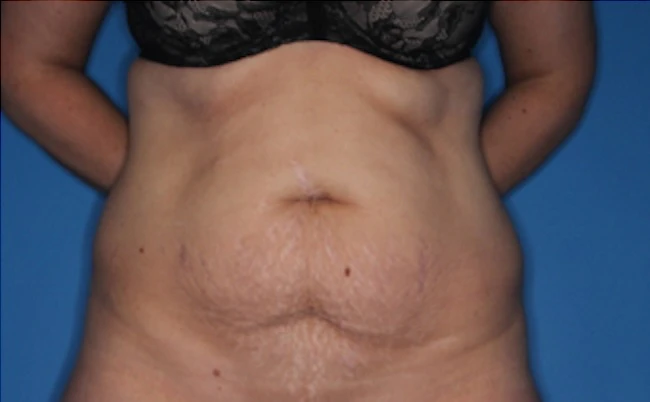 Before body contouring