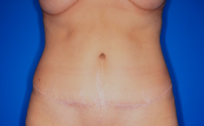 After body contouring