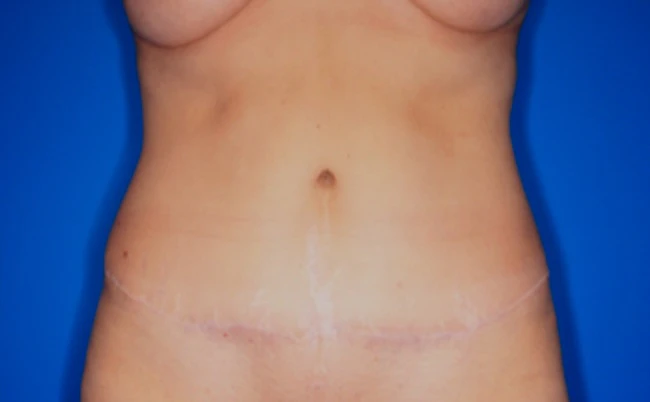 After body contouring