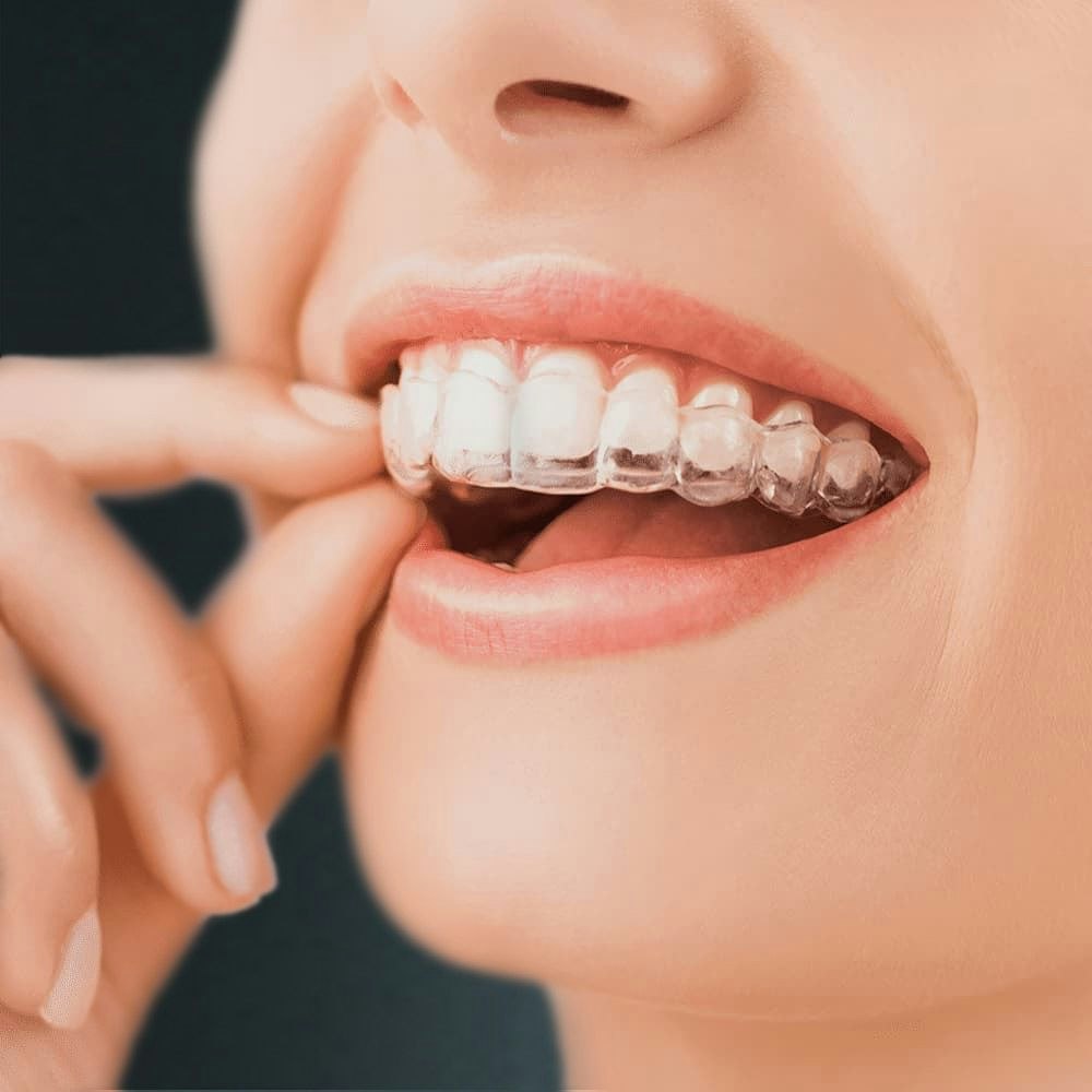 patient putting on Invisalign