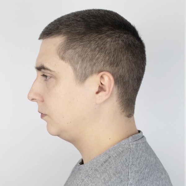 Profile of Man with Small Chin
