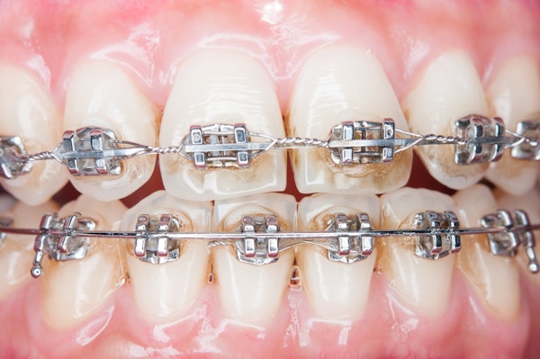 Stained teeth due to braces