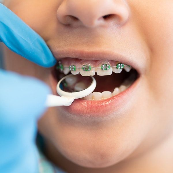 a child with braces being examined by a dentist