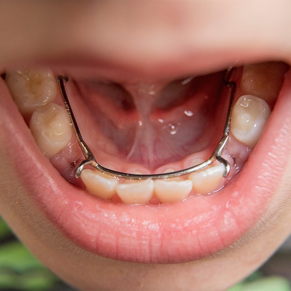 a child's mouth with a dental expander in place